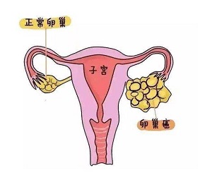 郑州治疗卵巢癌中医:卵巢癌的危害是什么