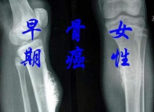 郑州治疗骨癌哪个医馆好:骨癌产生的原因