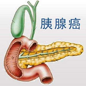 郑州中医肿瘤医师王卫昌详解:如何预防胰腺癌