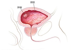 郑州膀胱肿瘤医馆排名:哪些因素容易诱发膀胱癌