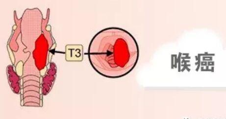 郑州中医:为什么吸烟者容易患喉癌