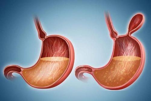 郑州御和堂中医:贲门癌的病因是什么