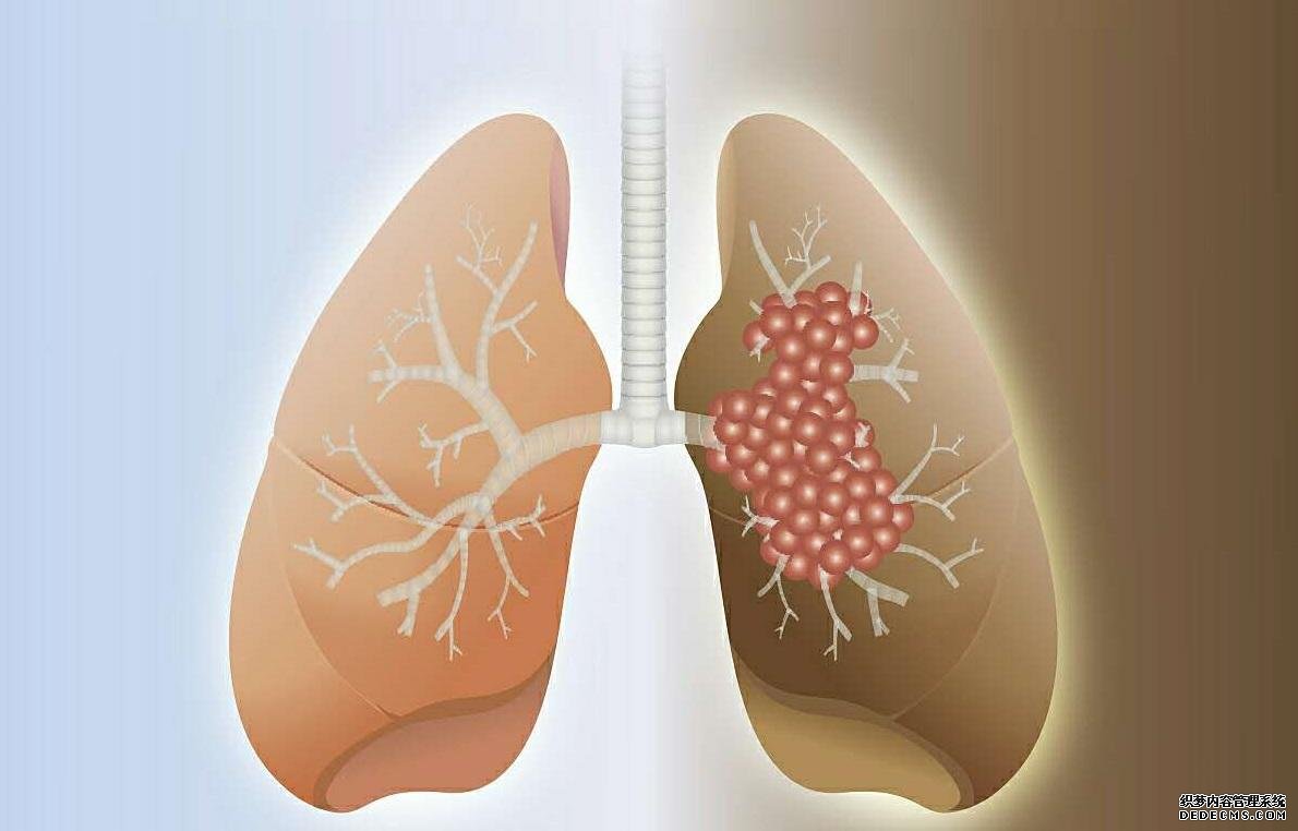 郑州中医治疗肺癌