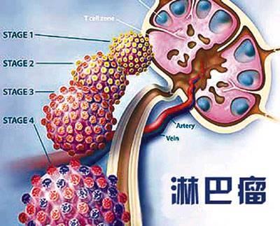 郑州中医治疗淋巴癌