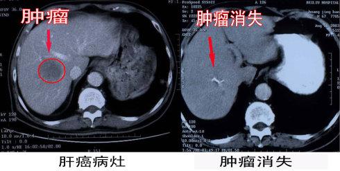 肝癌的早期症状有哪些_郑州御和堂中医