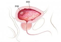 膀胱癌的危险因素有哪些?郑州中医师治疗膀胱癌