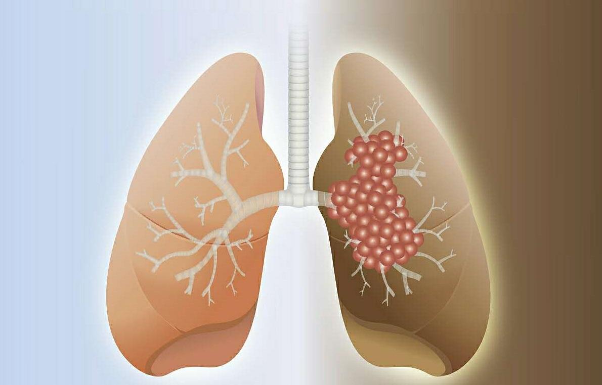 中医中药治疗肺癌效果如何