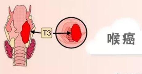 喉癌与咽炎有什么区别？了解一下